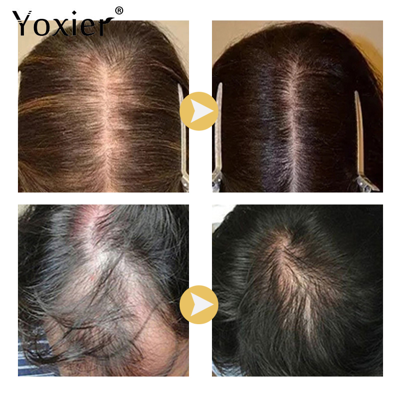 Intensive Growth Serum Prevent - Hair Care For Hair Loss 리뷰 및 가격
