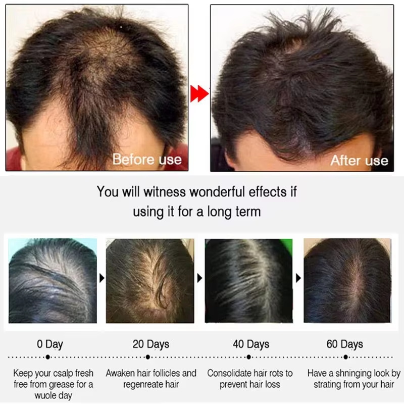 Ginger Hair Growth spray Anti  - Hair Care For Hair Loss 리뷰 및 가격